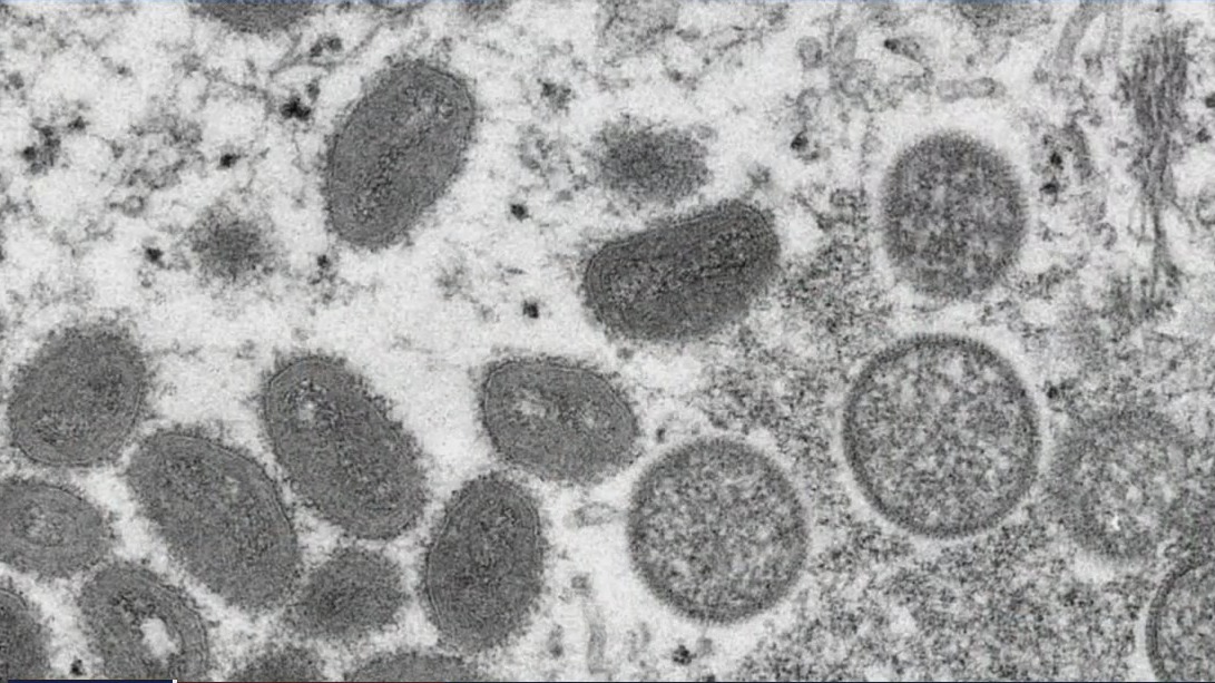 WHO declares monkeypox a global emergency