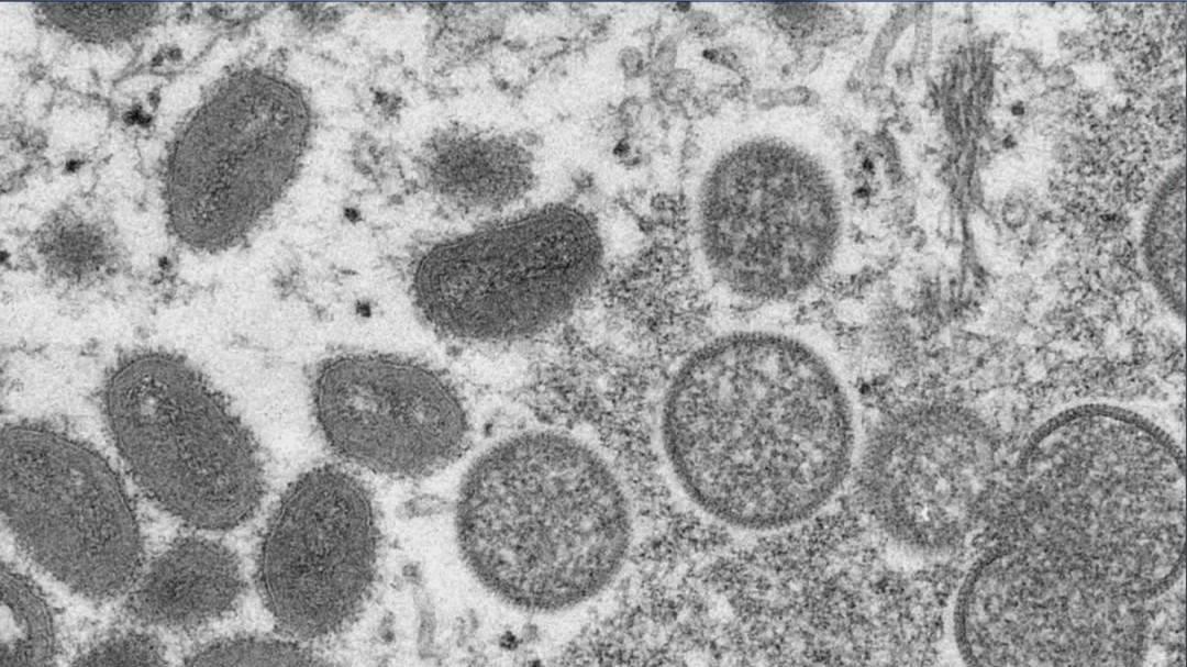 NYC is epicenter of U.S. monkeypox outbreak