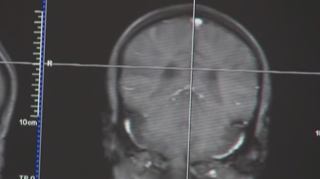 Medicare will cover new Alzheimer's drug