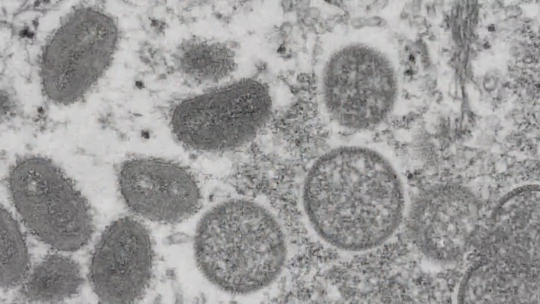 CDC tracking several clusters of people sickened by monkeypox