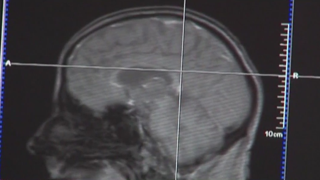 Understanding multiple sclerosis