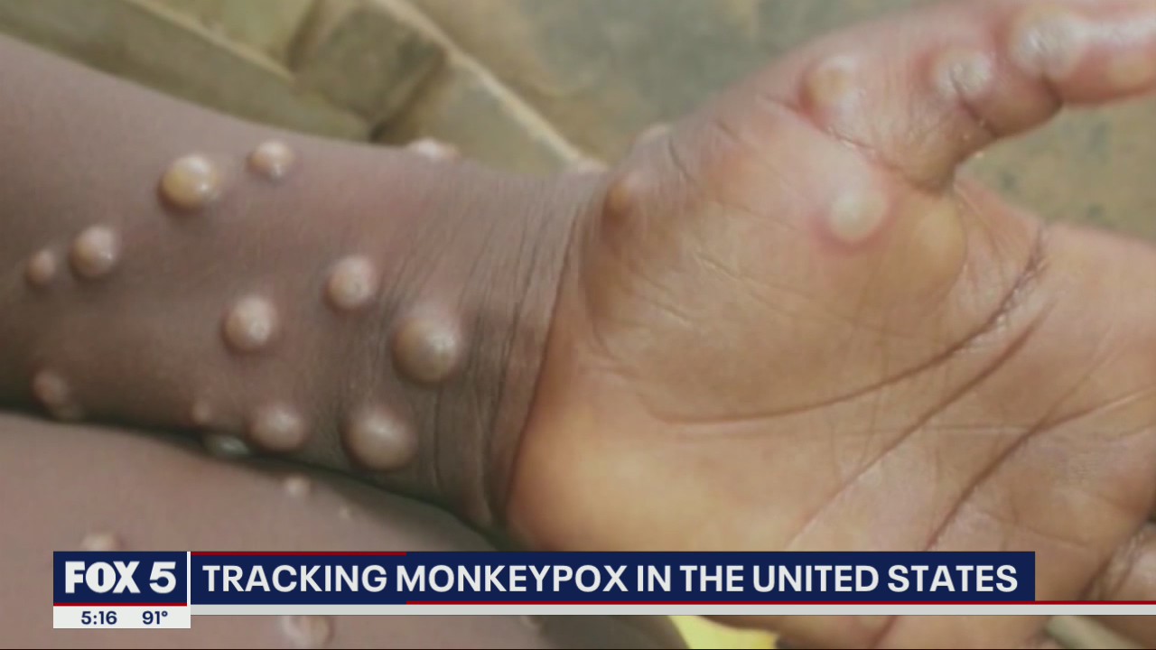 Demand for monkeypox vaccine outpaces supply