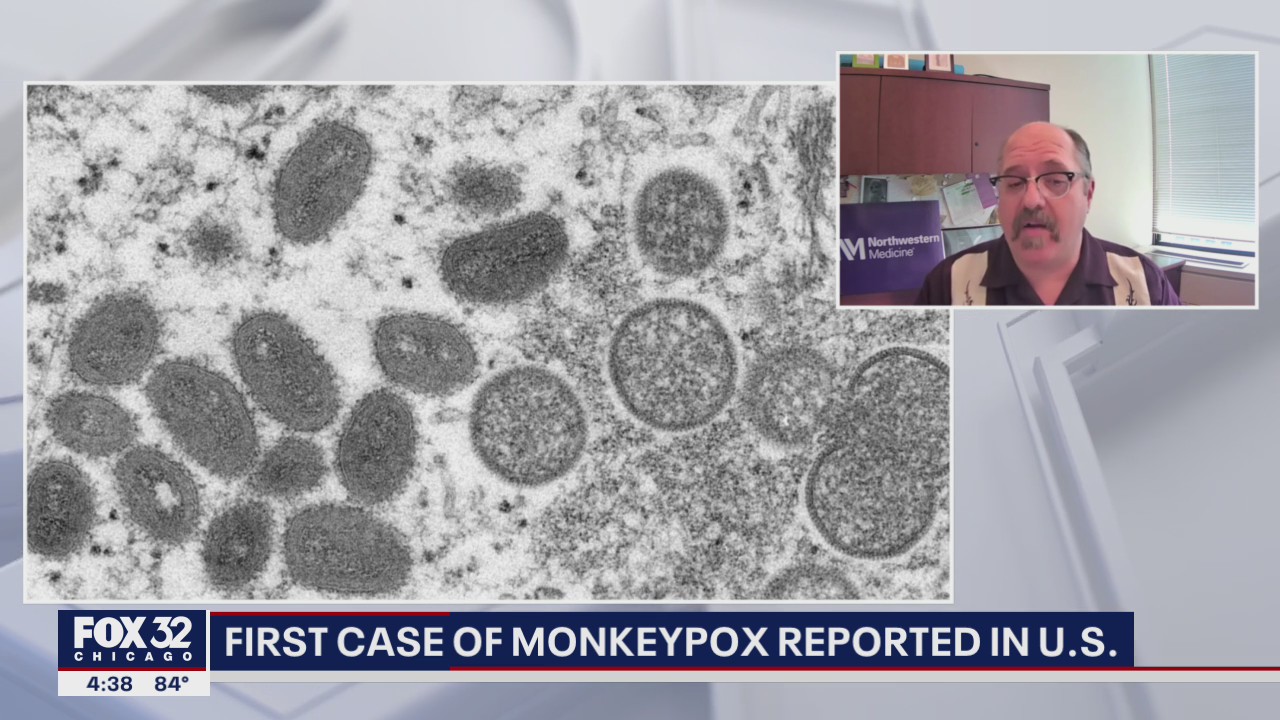 Monkeypox in the US: First recent case of Monkeypox reported in Massachusetts