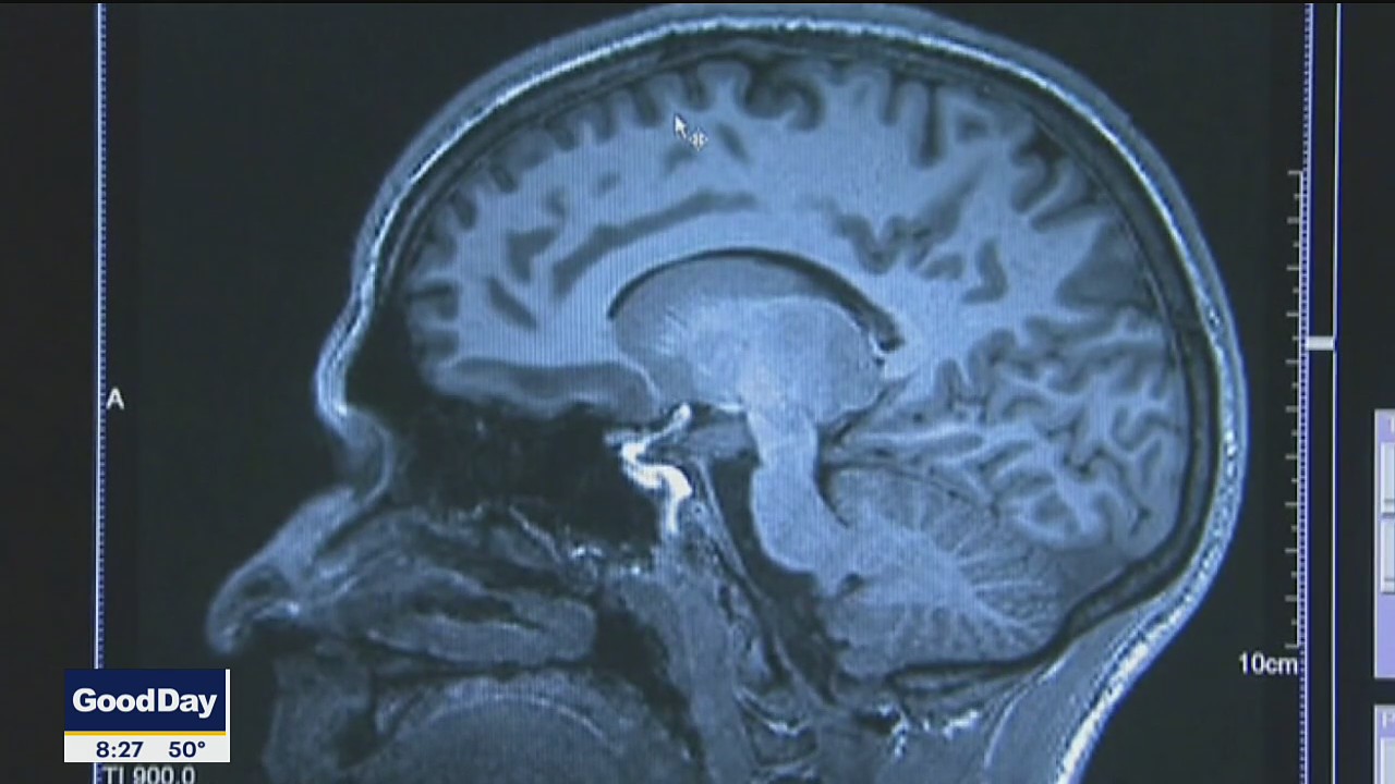 Report: Number of Alzheimer's cases growing