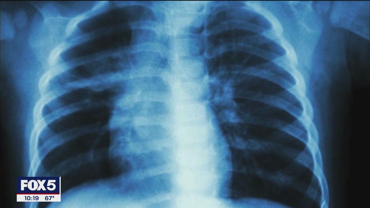 Tuberculosis cases on the rise in NYC