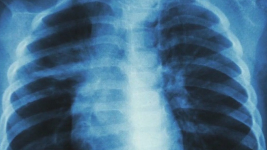 Tuberculosis cases on the rise