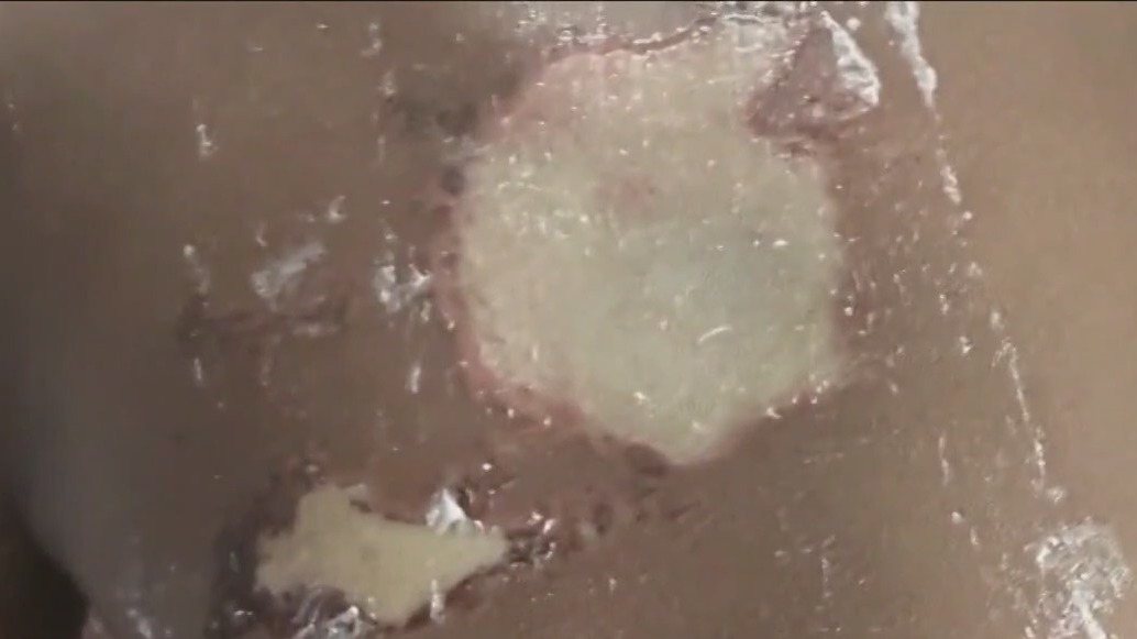 Across America: 12-year-old charged with throwing acid on girl