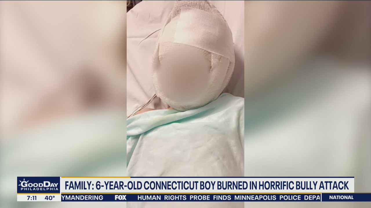 6-year-old Connecticut boy burned in horrific bully attack, family says