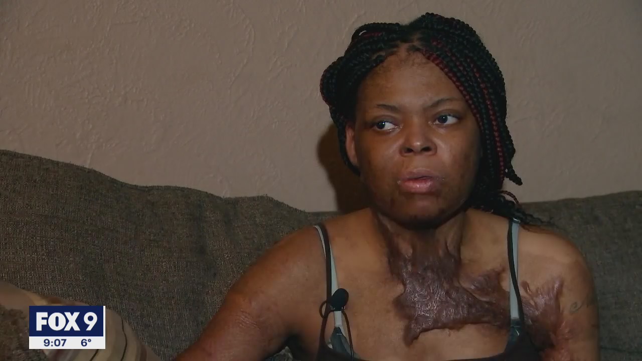 Woman set on fire by ex-boyfriend concerned he’ll get off easy on plea deal