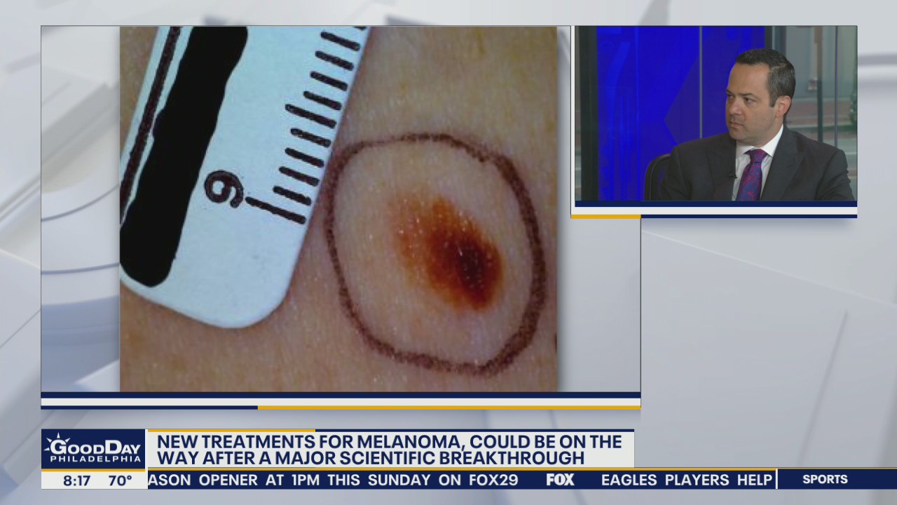Scientific breakthrough treatment could help treat melanoma, doctors say
