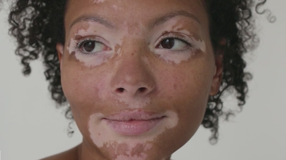 New treatment restores lost pigment in patients with vitiligo, dermatologists say