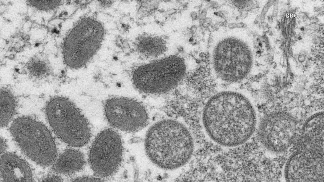 Monkeypox cases rising but officials say threat remains low