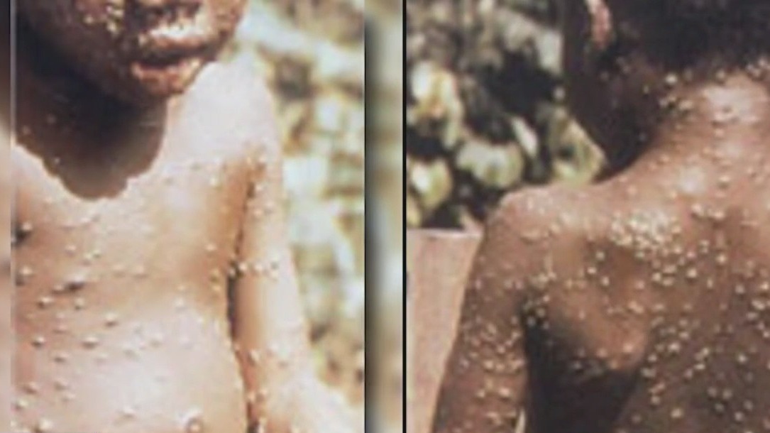US has its first confirmed case of Monkey Pox