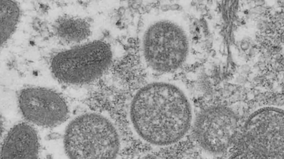 Evidence shows Monkeypox is spreading within the state of Texas