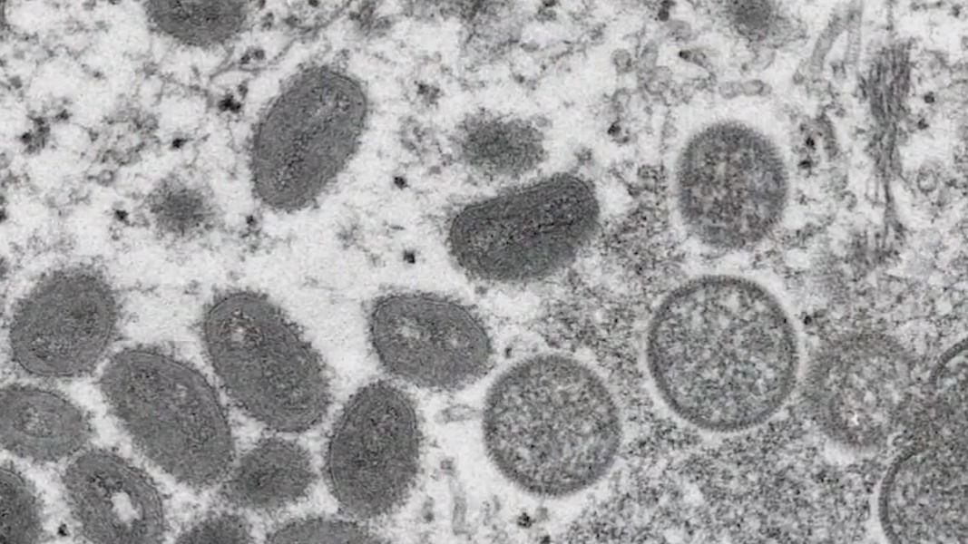 Monkeypox in Florida: What you need to know