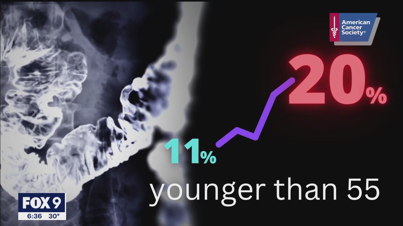 Increase in colorectal cases among younger adults spurs need for screenings