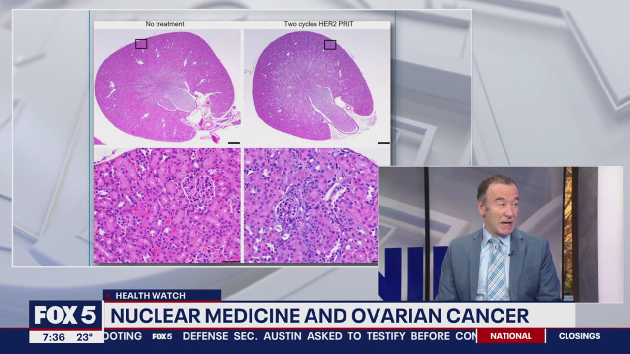 Nuclear medicine and ovarian cancer