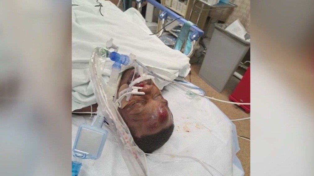 Milwaukee Brady Street hit-and-run victim 'happy to be alive'