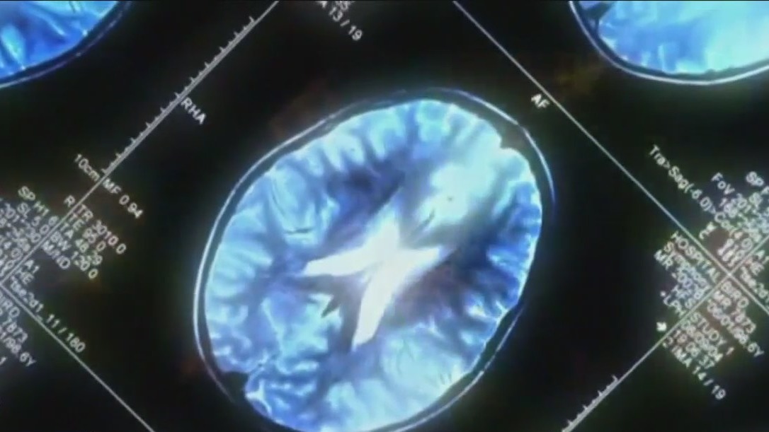 New therapy hopes to treat Alzheimers disease
