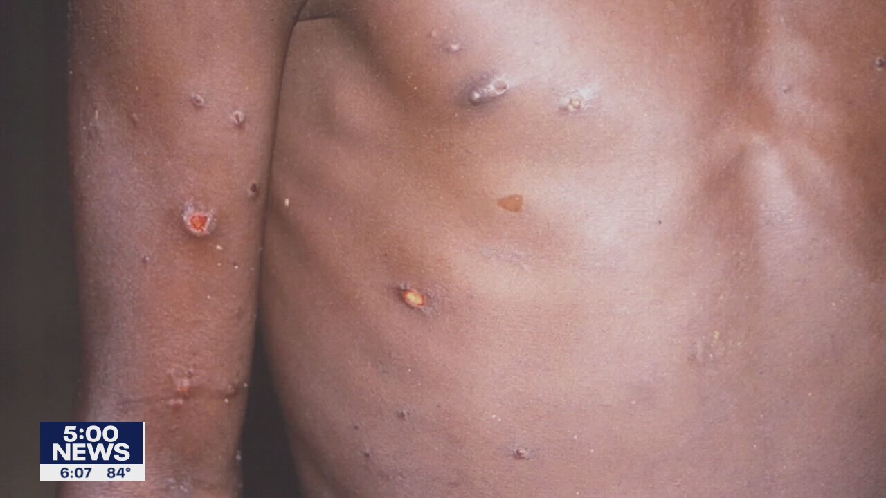 Hennepin County health officials talk monkeypox as cases grow