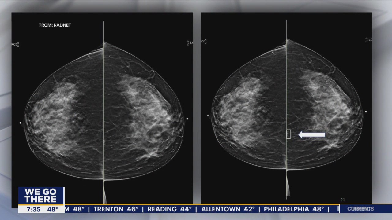 How AI being used in Delaware is detecting breast cancer