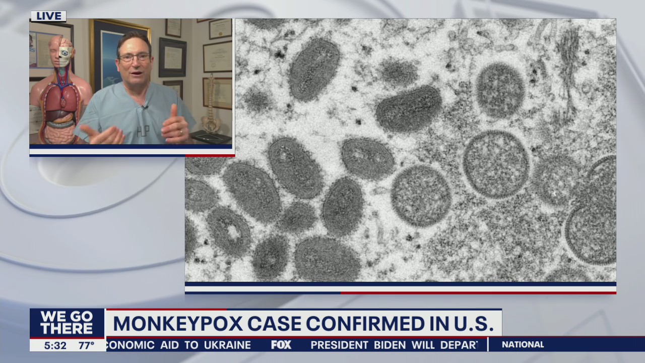 Monkeypox case in the United States