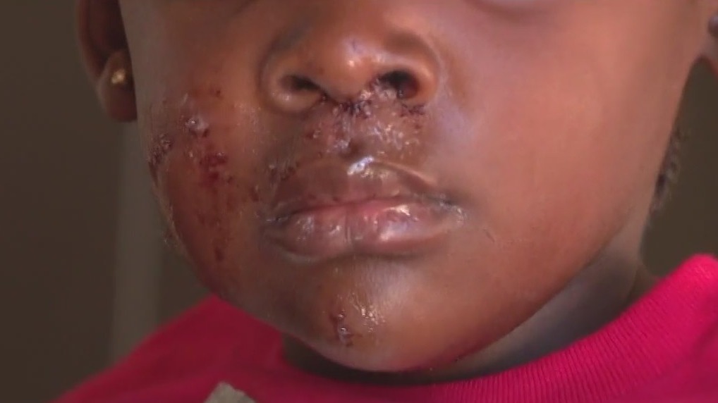 5-year-old girl survives brutal dog attack