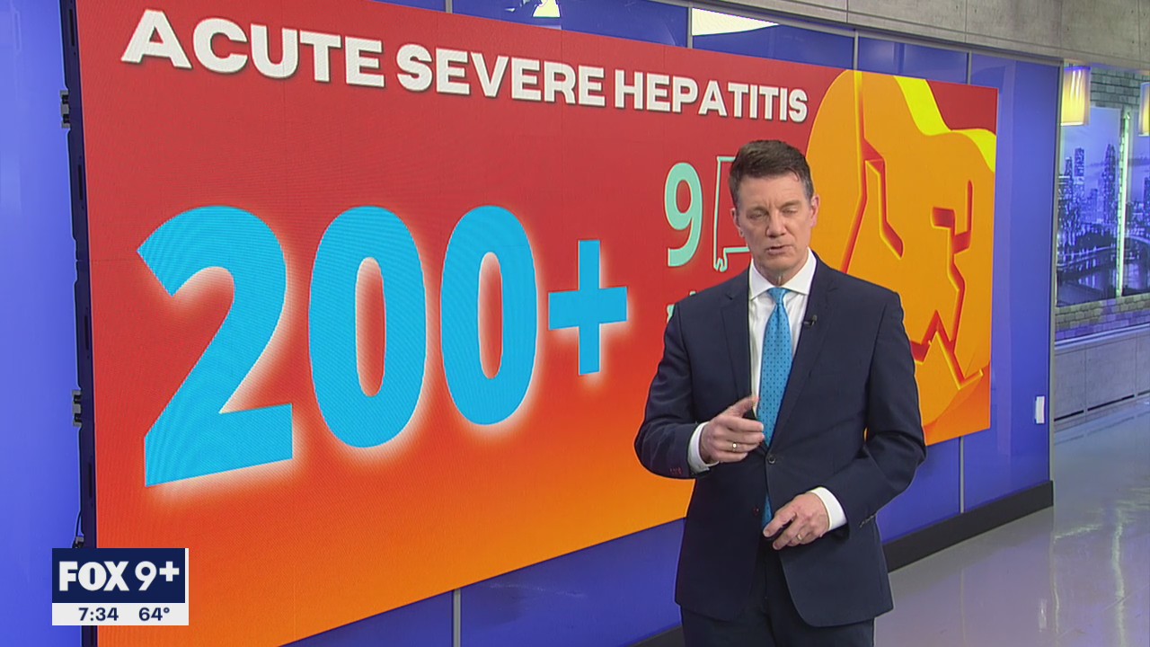 Doctors advise parents to be on lookout for hepatitis in children