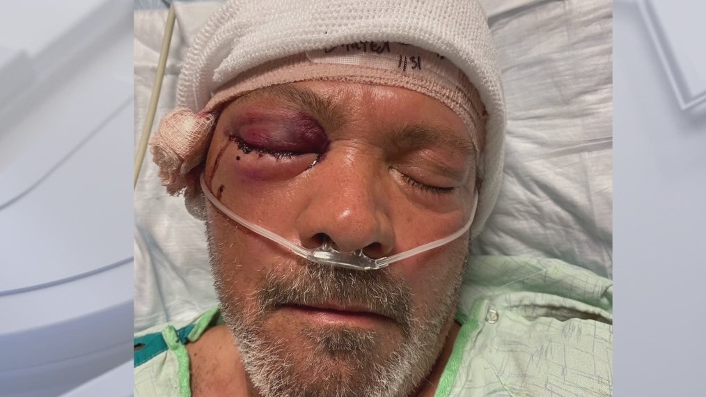 Napa grandfather recovering after gunshot wound to face on highway