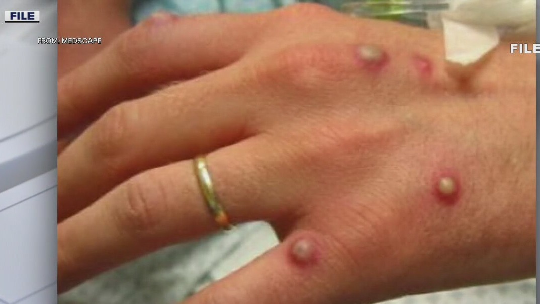 Texas reports first U.S. death in person with monkeypox
