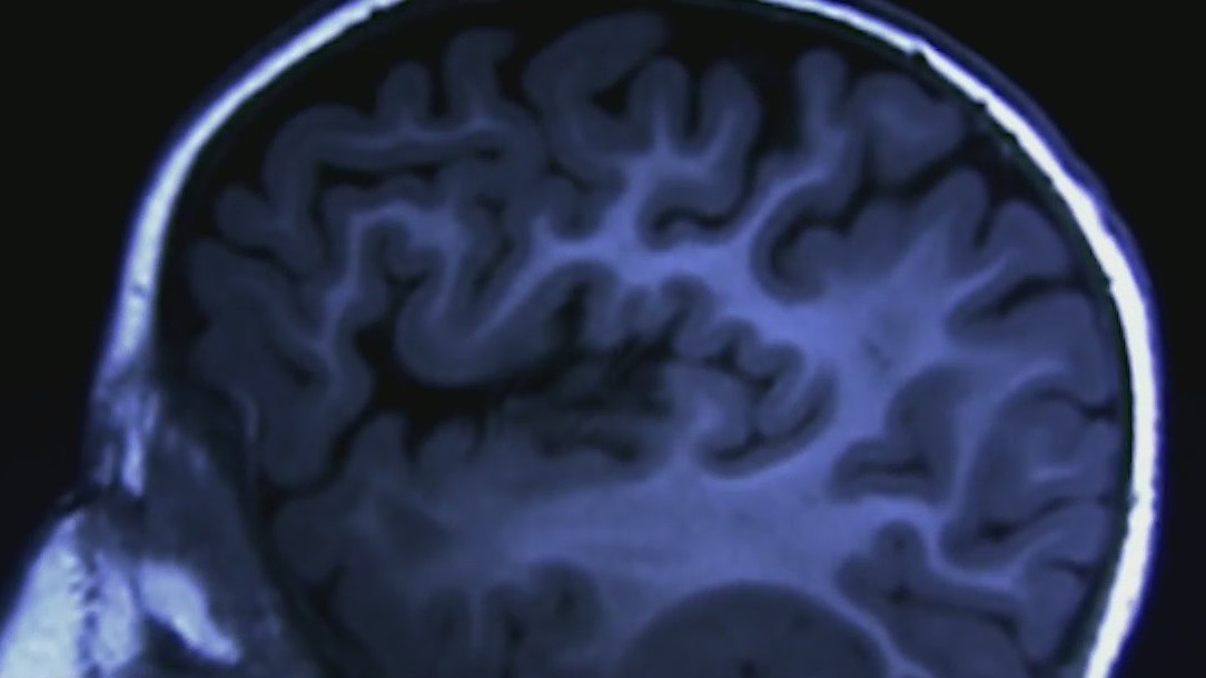 Study finds staying fit helps stave off Alzheimer's