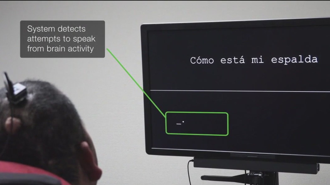 UCSF researchers build bilingual AI brain implant that helps stroke survivor communicate in two languages