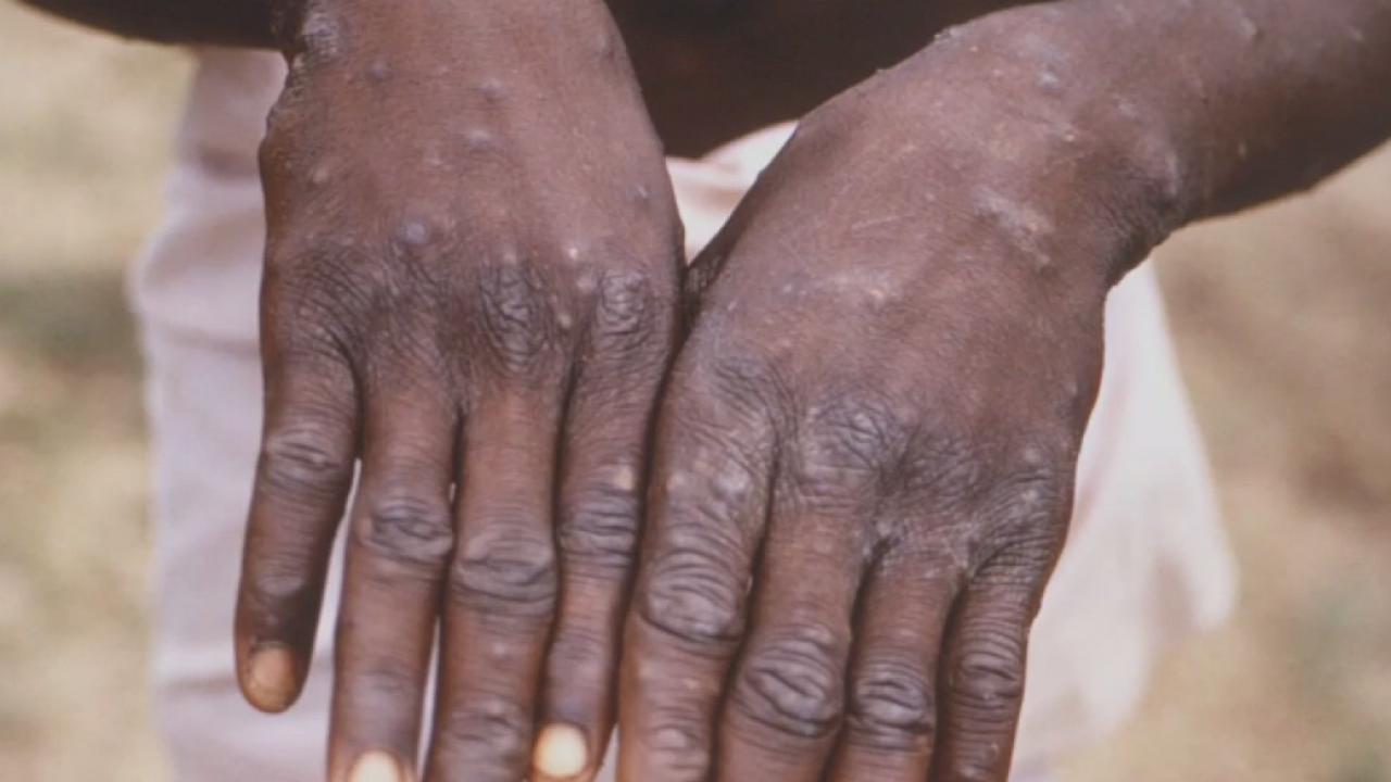 Health officials race to understand global monkeypox outbreak