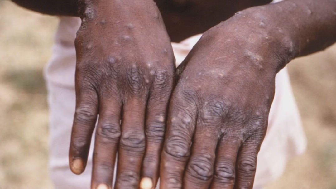 Dallas County health officials report first case of monkeypox in North Texas for 2022