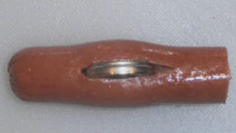 Battery ingestion: Symptoms and treatment