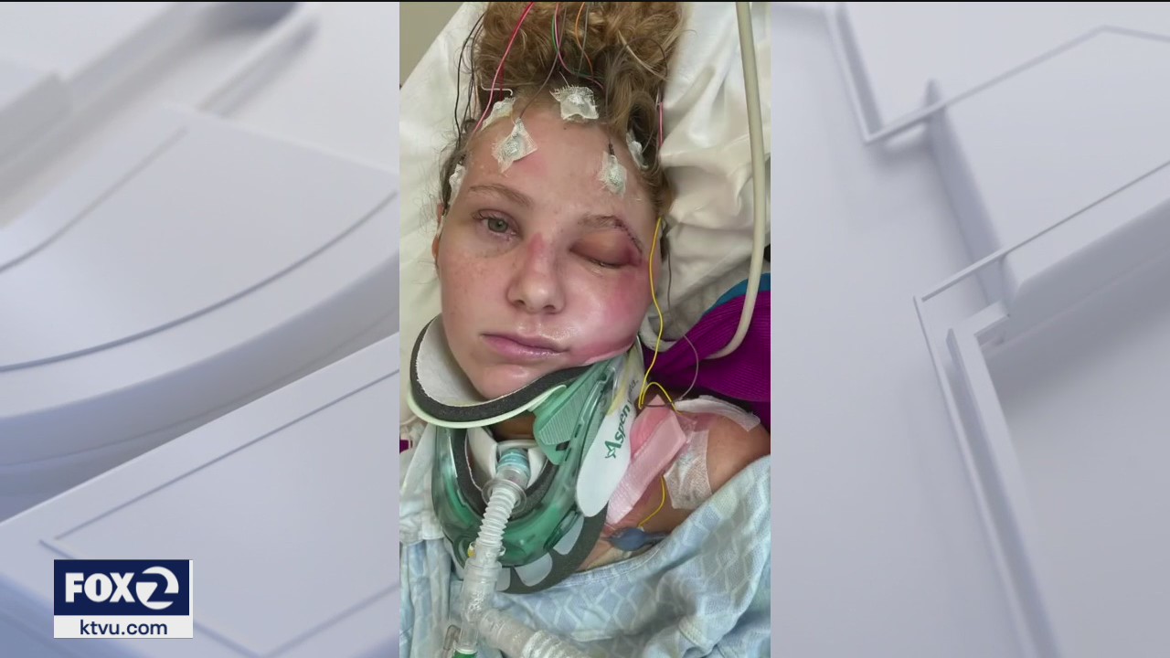 Bay Area travel blogger recovers from severe brain trauma, shares survival story