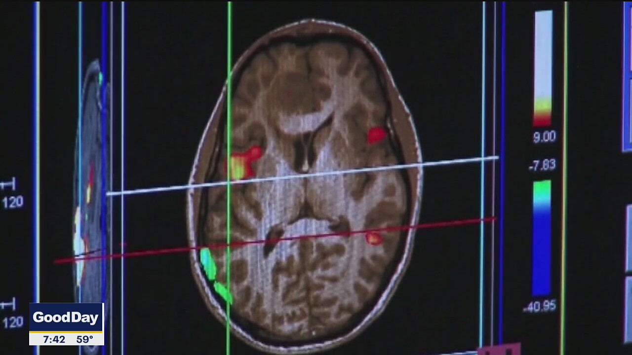 Groundbreaking Alzheimer's research could save millions