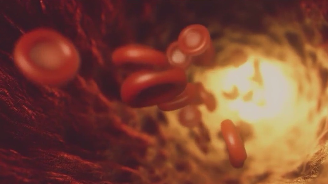 New treatment for Type 1 Diabetes prevention: FDA