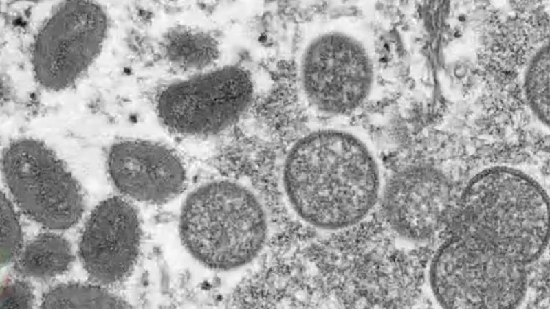 Possible Monkeypox case in NYC
