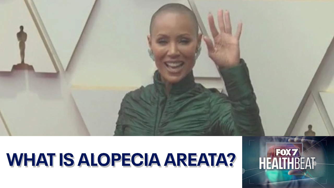 What is alopecia areata?